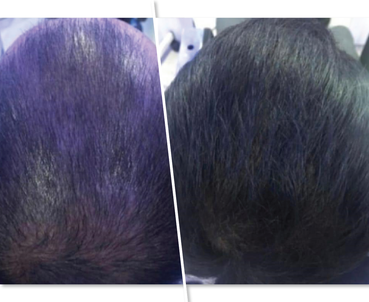 Before and After Anti hair Fall Treatment